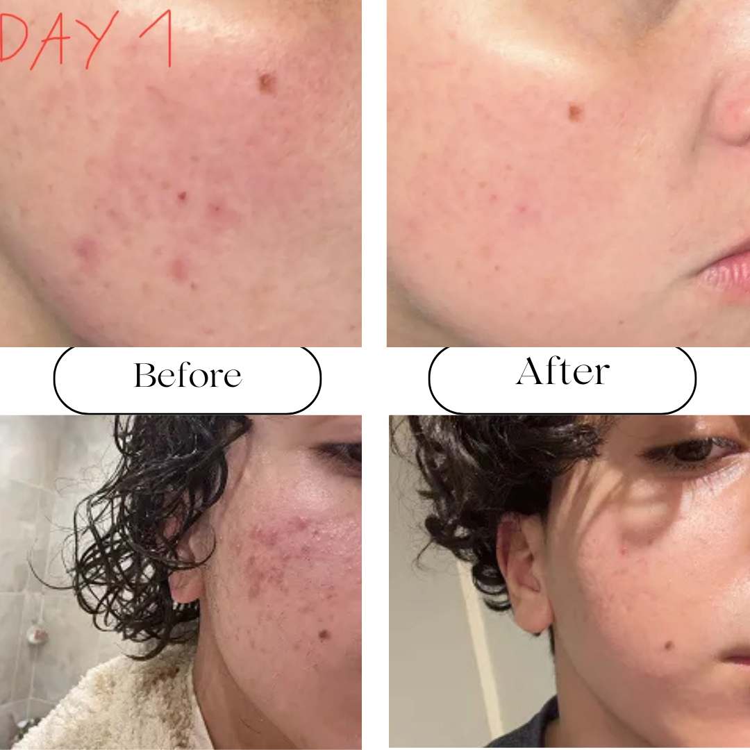 Azelaic Acid 10 Hyaluron Redness Soothing Serum