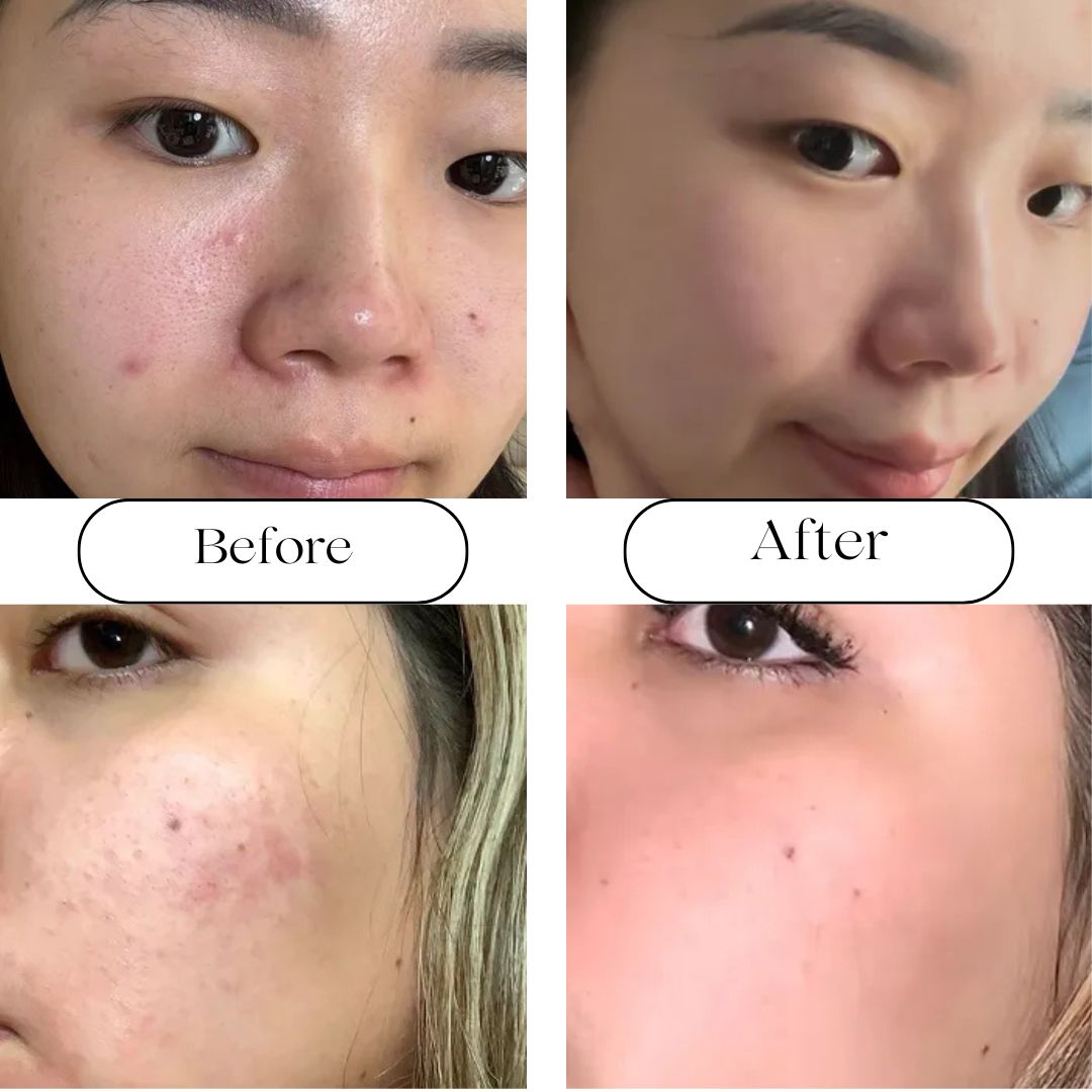 Azelaic Acid 10 Hyaluron Redness Soothing Serum